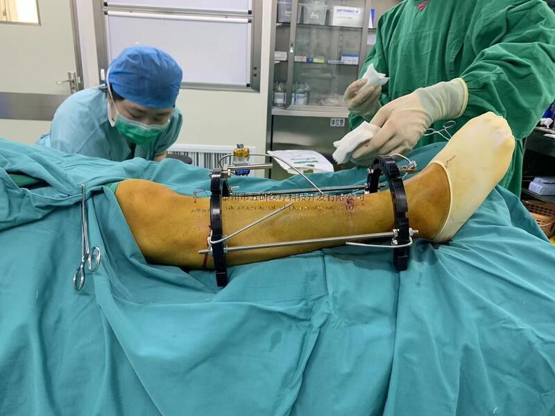 【望京醫院】不開刀治骨折——右脛腓骨骨折病例分享 【望京醫院】不開刀治骨折——右脛腓骨骨折病例分享